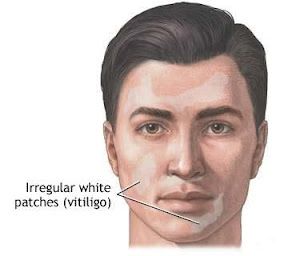Vitiligo (Leucoderma) Ayurvedic Treatment