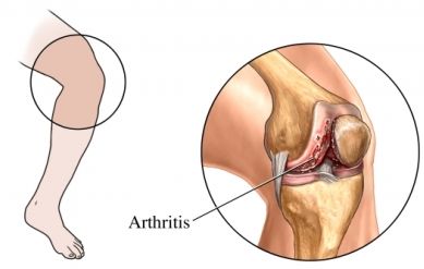 Arthritis Ayurvedic Cure